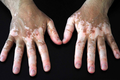 Vitiligo hastalarına umut ışığı